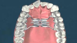 Expasion palatina rapida  Ortodoncia [upl. by Oglesby]