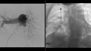 Case Discussion IR Catheter Directed Thrombolysis For High PE Burden [upl. by Siver818]