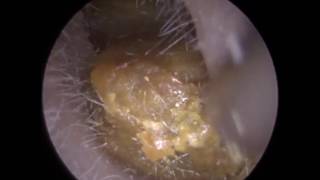 Ear Wax Removal Extractions of Dry Earwax in Eldery Person Ep 283 [upl. by Holmes]