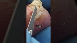 REMOVING A HUGE CALLUS IS RELIEF [upl. by Annaitsirk]