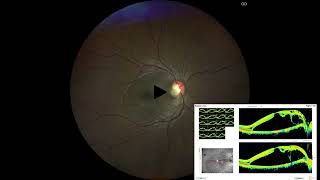 OPTIC DISK PIT ILM STUFF amp FOVEA SPARING ILM PEEL [upl. by Sussman]