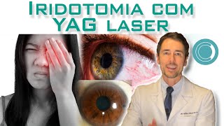 Iridotomia com YAG laser [upl. by Nelyt]