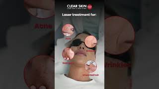 What Is Laser Skin Treatment and How Does It Work  Get the Facts  Clear Skin Pune [upl. by Akcired]