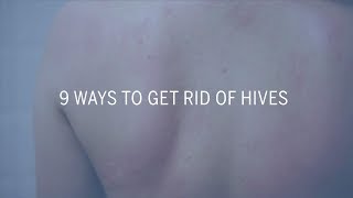 Hope for patients with hives  In Good Shape [upl. by Bradski]