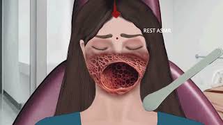 ASMR Animation treatment from infected mouth  2D Animation restasmr1 [upl. by Binky736]