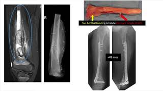 Femur Distal Osteosarkom Diz [upl. by Harmon]