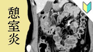 【おきらく版】第５回：憩室炎 大腸の小さな部屋が痛くなる憩室炎をCT画像で解説 [upl. by Pietrek]