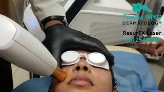 ResurFX Laser for Acne Scar Age Spots Wrinkles Hyperpigmentation at Twacha Skin Clinic Bijnor Meerut [upl. by Naloj620]