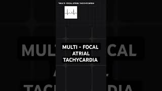 multifocal atrial tachycardia  ECG basics [upl. by Oiluj]