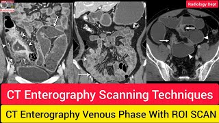 CT Enterography Scan Techniques in Hindi  How To do Ct Enterography Radiologydept ctscan ct [upl. by Fellows]