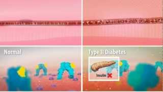 Insulin Resistance in Type 2 Diabetes [upl. by Timms961]