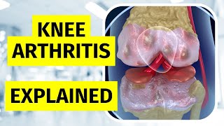 Knee Arthritis Explained  Treatments and Injections [upl. by Annasiul571]