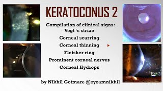 Keratoconus Part 2 Compilation of clinical signs Vogts striae Fleischer ring Hydrops etc [upl. by Naic]