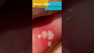 Mouth Ulcer  2 Drop 2 times a day  Best Homeopathic Medicine  How to Use [upl. by Ahsataj]