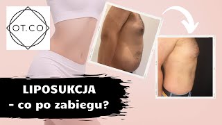 Liposukcja Vaser Lipo  Co po Zabiegu OTCO Clinic [upl. by Alli931]