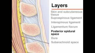 Lumbar puncture NEJM [upl. by Renate957]