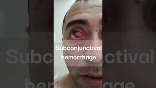 Subconjunctival hemorrhage ophthalmology hemorrhage health [upl. by Bolen]