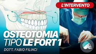 Chirurgia ortognatica  Osteotomia tipo Le Fort I  Video intraoperatorio [upl. by Nevaj]