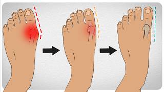 How to Fix Bunions in 5 Steps [upl. by Petie]