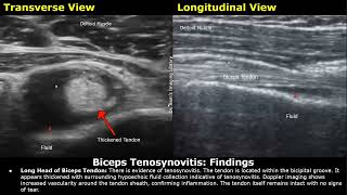 Shoulder Ultrasound Reporting  Supraspinatus Tendinosis Tears Biceps Tendon Joint Effusions USG [upl. by Anelrad167]