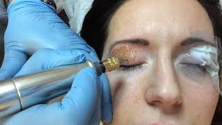 Fibroblast Eyelid Lift Plasma Treatment [upl. by Leunamme]