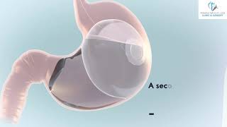 Elipse Intragastric Balloon Animation Video [upl. by Odnanreh]