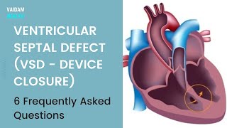 Ventricular septal defectVSD 6 Frequently Asked Questions [upl. by Godfry]