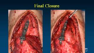 Fixation Options and Techniques for Distal Humerus Fractures VuMedi [upl. by Newhall]