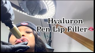 Hyaluron Pen Lip Fillers  Before amp After Needleless 1ml [upl. by Zildjian143]