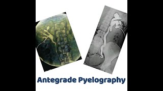 antegrade Pyelography [upl. by Fitz]