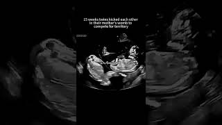 Ultrasound scan In Pregnancy [upl. by Arabele]