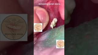 Understanding Tonsil Stones Symptoms Treatment and Prevention [upl. by Hurless]