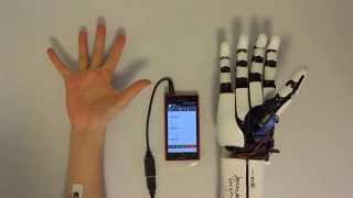 handiii accessible myoelectric hand prosthesis [upl. by Ielirol]