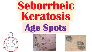 Seborrheic Keratosis “Age Spots”  Risk Factors Causes Skin Lesions Diagnosis Treatment [upl. by Vedette]