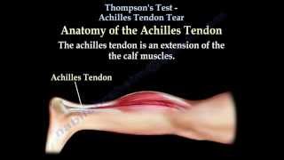 Thompsons Test Achilles Tendon Tear  Everything You Need To Know  Dr Nabil Ebraheim [upl. by Ettevram]