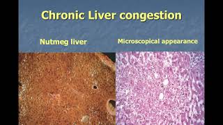 Hyperemia and Congestion [upl. by Enilhtak]