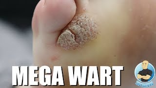 MONSTER MOSAIC WART REMOVAL [upl. by Peck]