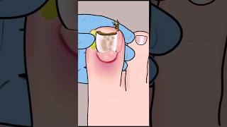 ASMR Ingrown Toenail Removal Treatment asmr animation satisfying viral shorts youtubeshorts [upl. by Emanuel408]