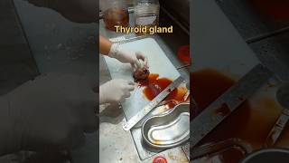 Cystic thyroid gland gross pathology [upl. by Lilly]