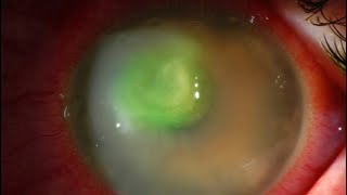 Corneal ulcer  treatment  Feedback patient review [upl. by Swayne]