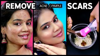 Acne Scars Home Remedies in Tamil  Pimple Marks Removal at Home [upl. by Cosimo]