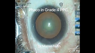 Tips and Tricks Phaco in Grade 4 PPC Posterior Polar Cataract  Nuclear Sclerosis [upl. by Ydderf]