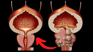 Top 5 Getränke für die Prostata  Trinken Sie dies um eine vergrößerte Prostata zu verkleinern [upl. by Hiltan132]