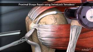 Proximal Biceps Repair using SwiveLock Tenodesis [upl. by Sokin625]