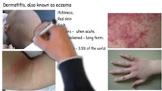 Dermatitis vs Eczema are they same Types of dermatitis symptoms prognosis and treatment [upl. by Shute]