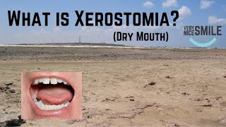 What is Xerostomia [upl. by Erehs158]