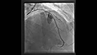 coronary perforation primary pci [upl. by Nagaem450]