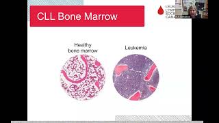 Chronic lymphocytic leukemia CLL What it is when to treat and what’s ahead [upl. by Alderson]