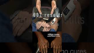 FIX 100 VITILIGO WITH PIGMENTOZ  VITILIGO PERMANENT TREATMENT WHITE SPOT CURE vitiligocures [upl. by Otsedom]