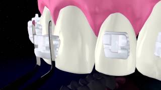 TruKlear Bracket product film [upl. by Persons]